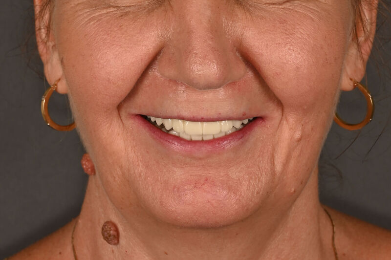 Zâmbet lateral dreapta_dupa